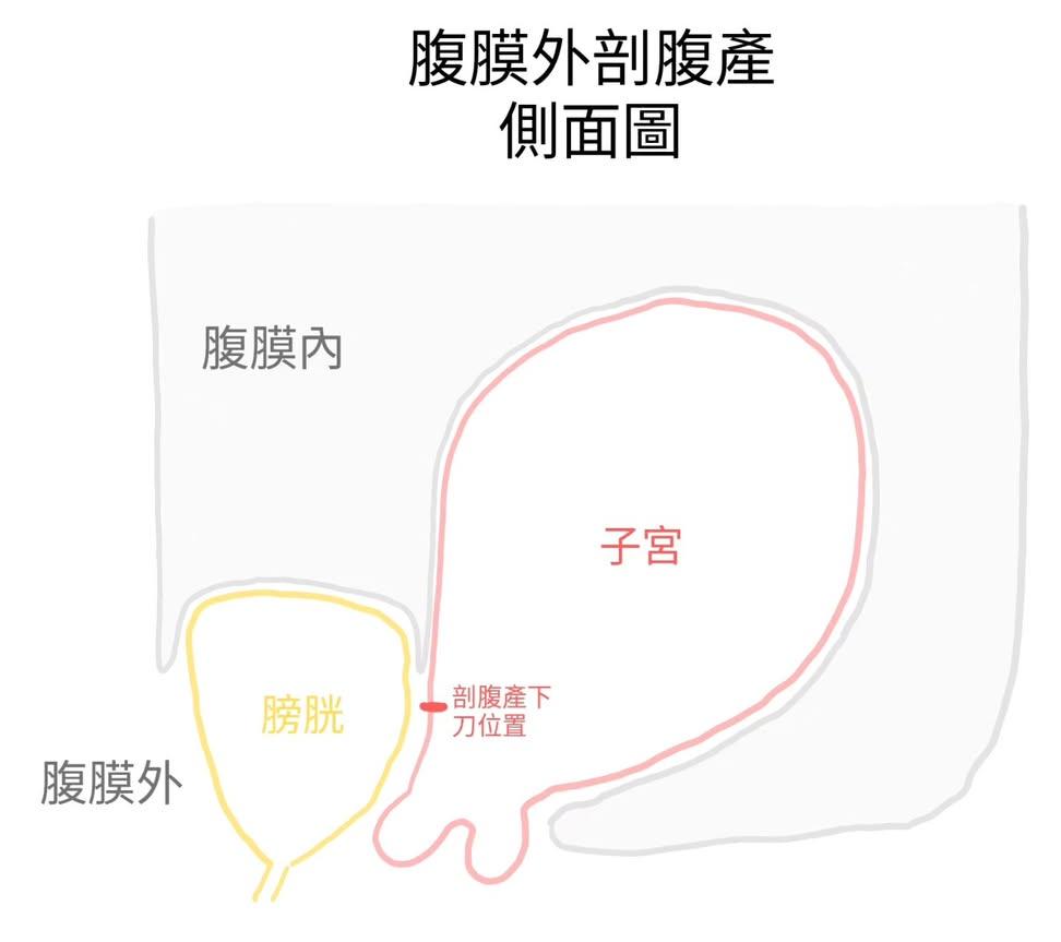 腹膜外剖腹產側面圖：手術從膀胱與腹膜之間的夾縫進入，不切開腹膜、不進入腹腔，直接到達子宮下段