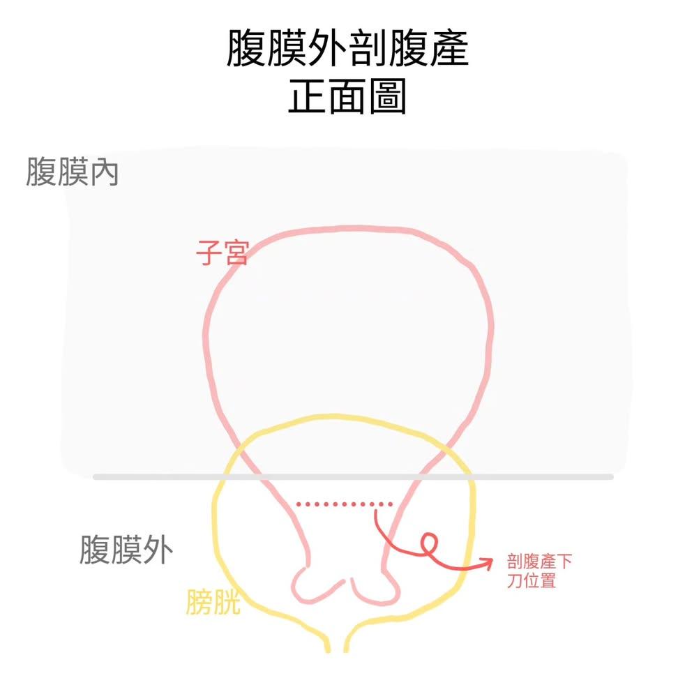 腹膜外剖腹產正面圖：從正面看，手術路徑在腹膜外、膀胱上方到達子宮下段